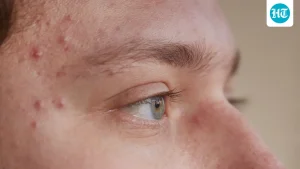 Experienced acne breakouts right before major events? Physician Dr Kunal Sood