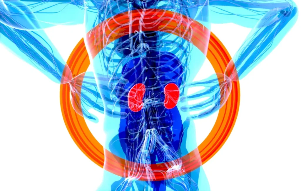 A practical guide to know if you have kidney stones? Nephrologist: A practical reader guide