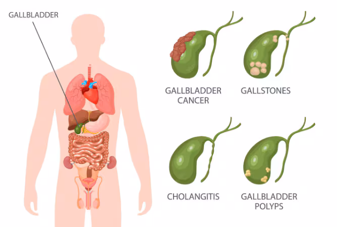 Is it just heartburn, or is your gallbladder secretly staging a coup?: A practical reader guide