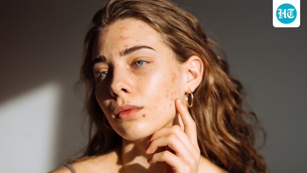 Your acne may keep coming back despite you doing everything right: A practical reader guide