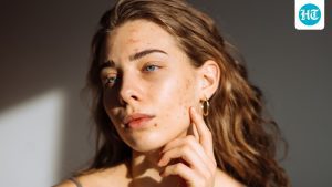Your acne may keep coming back despite you doing everything right: A practical reader guide