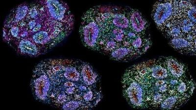 Supreme Court orders autism patients on stem cell therapy to register: A practical reader guide